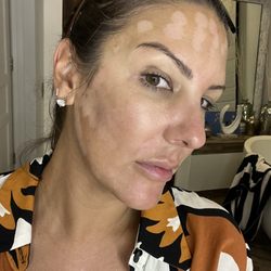 Cosmetic and Reconstructive Specialists of Florida - Burns
