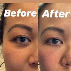Metamorphosis Holistic MedSpa - Under eye Filler using 1cc of Belotero