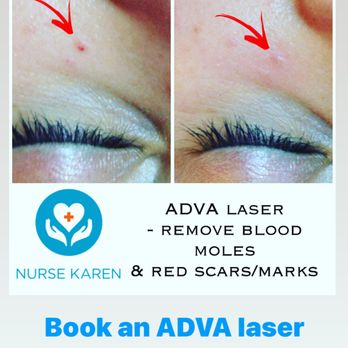 Nurse Karen - Vascular laser for blood moles, angiomas, broken capillaries, spider veins amd more! No downtime. - Aestheticians Near Me - Austin, Texas