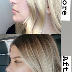 Newman Temecula Plastic Surgery - Before and after