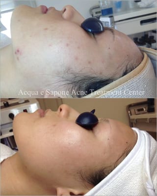 AES Acne Clinic by null