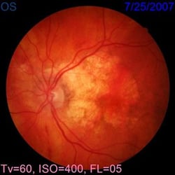 Michael Vaske, OD - Advanced Macular Degeneration