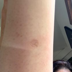 Bend Dermatology Clinic - Multiple scars: all of them are atrophic, pigmented and heavily textured