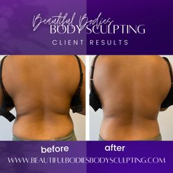 Beautiful Bodies Body Sculpting - Ultrasonic cavitation and laser Lipo back treatment