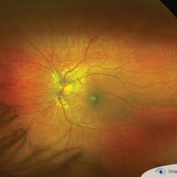 Ali & Patel, OD - OPTOMAP RETINAL SCAN- Ultra- Widefield Retinal Imaging