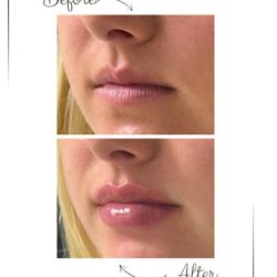 NU Med Spa - Another day another slay! Check out these gorgeous lips done by our PA Samira