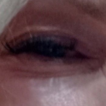 Lash Lab Express - Swelling and irritation from allergic reaction that could have been avoided if a skin test was offered or even mentioned! - Eyelash Service Near Me - Parlin, New Jersey