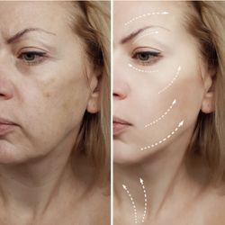 Koco Medical Aesthetics - Before and After Dermal Filler Service