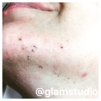 Ingrown Hairs Tend To Burst Out From Intensity Of Laser Clearing