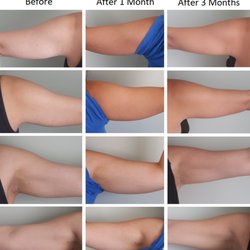 Curves & Contours - Client received one round of Fat Freezing treatments on both arms. Results shown are after one and three months.