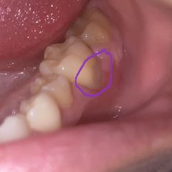 Capehart Family Dentistry - Notice the gum cut from the molar.