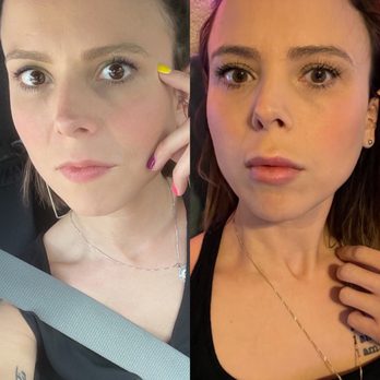 The Lotus Aesthetics and Wellness - Before and after masseter injections/lip filler - Medical Spas Near Me - Helotes, Texas The Lotus Aesthetics and Wellness - Before and after masseter injections/lip filler - Medical Spas Near Me - Helotes, Texas