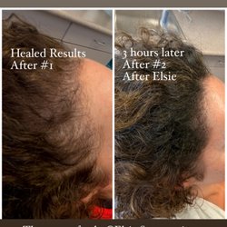 SMP Hair Clinic The Queen Of Scalp - A density fill treatment is performed while keeping your existing hair long.
Natural results by Elsie
