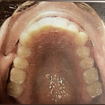 Fishbein Orthodontics - Pensacola - Maxillary Teeth (Before Invisalign Photo) already aligned as you can see. - Orthodontists Near Me - Pensacola, Florida Fishbein Orthodontics - Pensacola - Maxillary Teeth (Before Invisalign Photo) already aligned as you can see. - Orthodontists Near Me - Pensacola, Florida