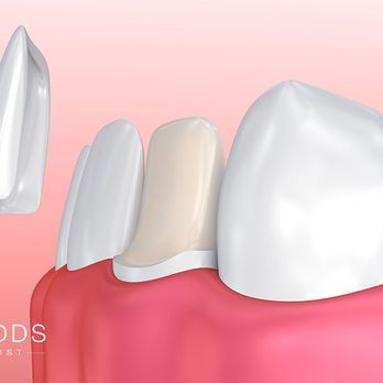 Barsky DDS - Dental Veneer placement. - Cosmetic Dentists Near Me - Miami, Florida Barsky DDS - Dental Veneer placement. - Cosmetic Dentists Near Me - Miami, Florida