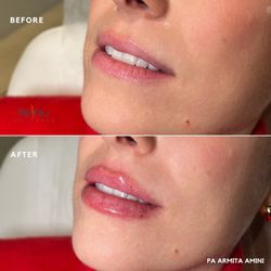 Renu Med Lounge - Before and After: Lip Filler