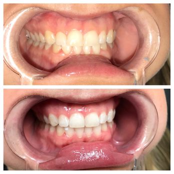 Xpress Whitening - Teeth Whitening Near Me - Fort Worth, Texas Xpress Whitening - Teeth Whitening Near Me - Fort Worth, Texas