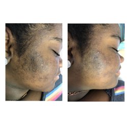 Peace Mind Beauty Day Spa - Before and after treatment