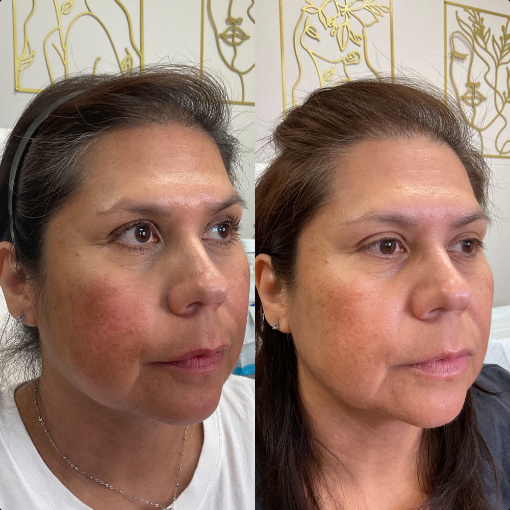 INJECTOR ARTIST AESTHETICS 11 Photos 16918 Bulverde Rd, San Antonio