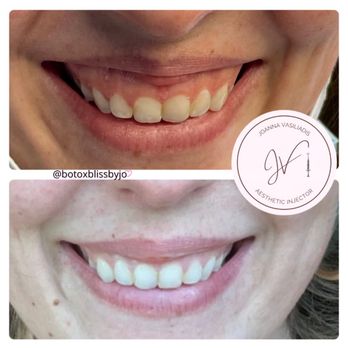 Pure Bliss Aesthetics - Gummy smile treatment using dysport injections - Medical Spas Near Me - Worcester, Massachusetts Pure Bliss Aesthetics - Gummy smile treatment using dysport injections - Medical Spas Near Me - Worcester, Massachusetts