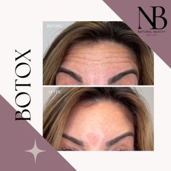 The Natural Beauty Med Spa - Get rid of those forehead lines with Botox! Quick and easy, Botox erases those forehead lines quickly!