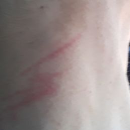 Both sides of my neck look like I got in a fight with a cat! Both sides of my neck look like I got in a fight with a cat!