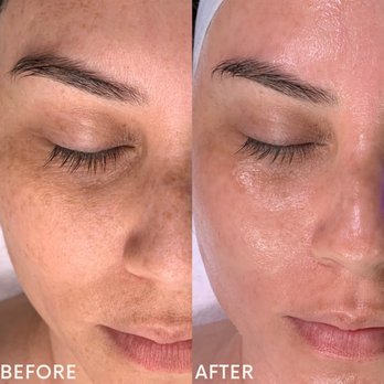 Transformative Beauty Spa - Deluxe Hydrafacial Treatment results - Skin Care Near Me - Folsom, California Transformative Beauty Spa - Deluxe Hydrafacial Treatment results - Skin Care Near Me - Folsom, California