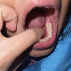 Rancho San Diego Dental Group - The injured gum