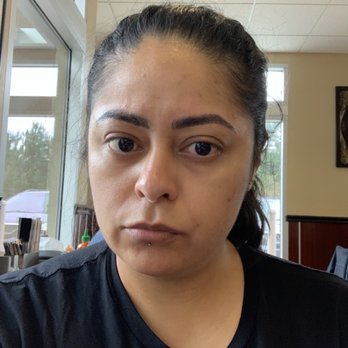 Miracullum Spa - After procedure. Wasn't even red when I left.  Day 1 - Medical Spas Near Me - Walnut Creek, California