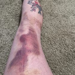 Mission Surgery Center - Bruises on leg