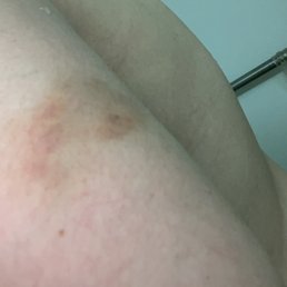 Bruise