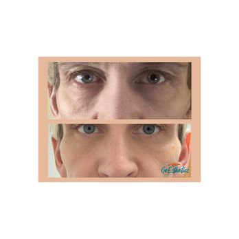 Go Esthetics - Tear trough filler (under eye crease). - Medical Spas Near Me