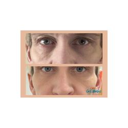Go Esthetics - Tear trough filler (under eye crease).