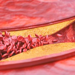 Gerti Tashko, MD - Cardiovascular disease