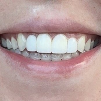 Surfside Dental - Cape Coral - Whitening - general dental - General Dentistry Near Me - Cape Coral, Florida Surfside Dental - Cape Coral - Whitening - general dental - General Dentistry Near Me - Cape Coral, Florida
