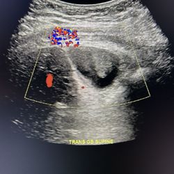 Kadlec Outpatient Imaging - Here's the gallbladder cancer that they called sludge.