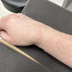 The Plaza Ice-Skating Rink - Broken wrist