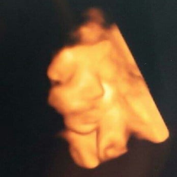 4D Miracles - Our little boy at 33 weeks. - Ultrasound Imaging Centers Near Me - Fremont, California 4D Miracles - Our little boy at 33 weeks. - Ultrasound Imaging Centers Near Me - Fremont, California