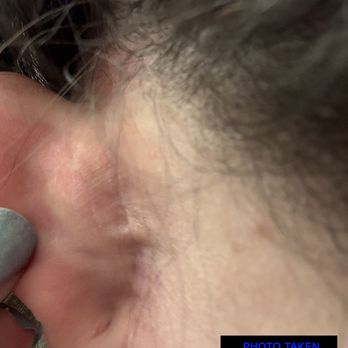 Raj Joyesh, MD - Raj Plastic Surgery - The scar behind my ear has become a painful, intrusive keloid. Apr 13, 2025 - Plastic Surgeons Near Me - Westlake, Ohio Raj Joyesh, MD - Raj Plastic Surgery - The scar behind my ear has become a painful, intrusive keloid. Apr 13, 2025 - Plastic Surgeons Near Me - Westlake, Ohio