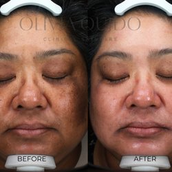 O Skin Medspa - Hyperpigmentation