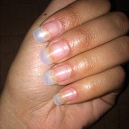 The white part that is receding is the nail that is LIFTING from the bed The white part that is receding is the nail that is LIFTING from the bed