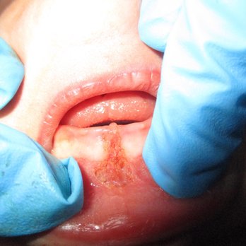Team Tongue Tie - Upper lip after procedure - Lactation Services Near Me - Morehead, Kentucky