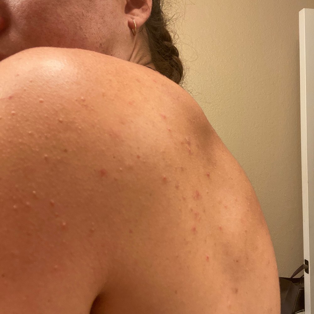 Massage Angel Spa - Skin reaction to massage oil - Massage Therapy Near Me - Temecula, California