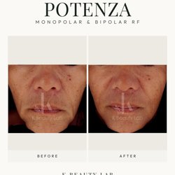 K Beauty Lab - POTENZA RF Microneedling | Before & After