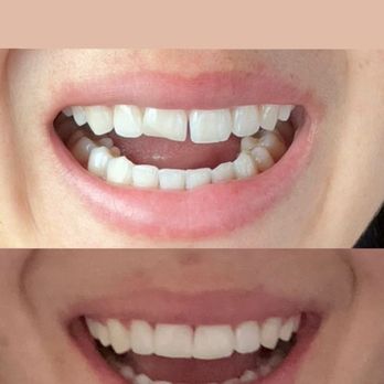 Del Rio Dental Studio | General, Family and Cosmetic Dentistry - here is a before and after for reference - General Dentistry Near Me - Hayward, California Del Rio Dental Studio | General, Family and Cosmetic Dentistry - here is a before and after for reference - General Dentistry Near Me - Hayward, California