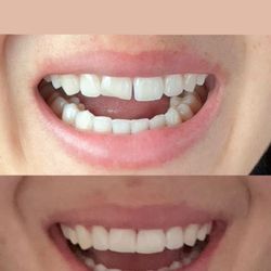 Del Rio Dental Studio | General, Family and Cosmetic Dentistry - here is a before and after for reference