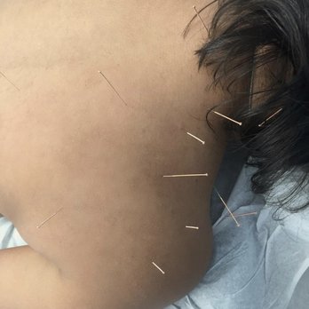 Pema Chen Acupuncture - Initial Acupuncture Treatment - Acupuncture Near Me - Englewood, New Jersey Pema Chen Acupuncture - Initial Acupuncture Treatment - Acupuncture Near Me - Englewood, New Jersey