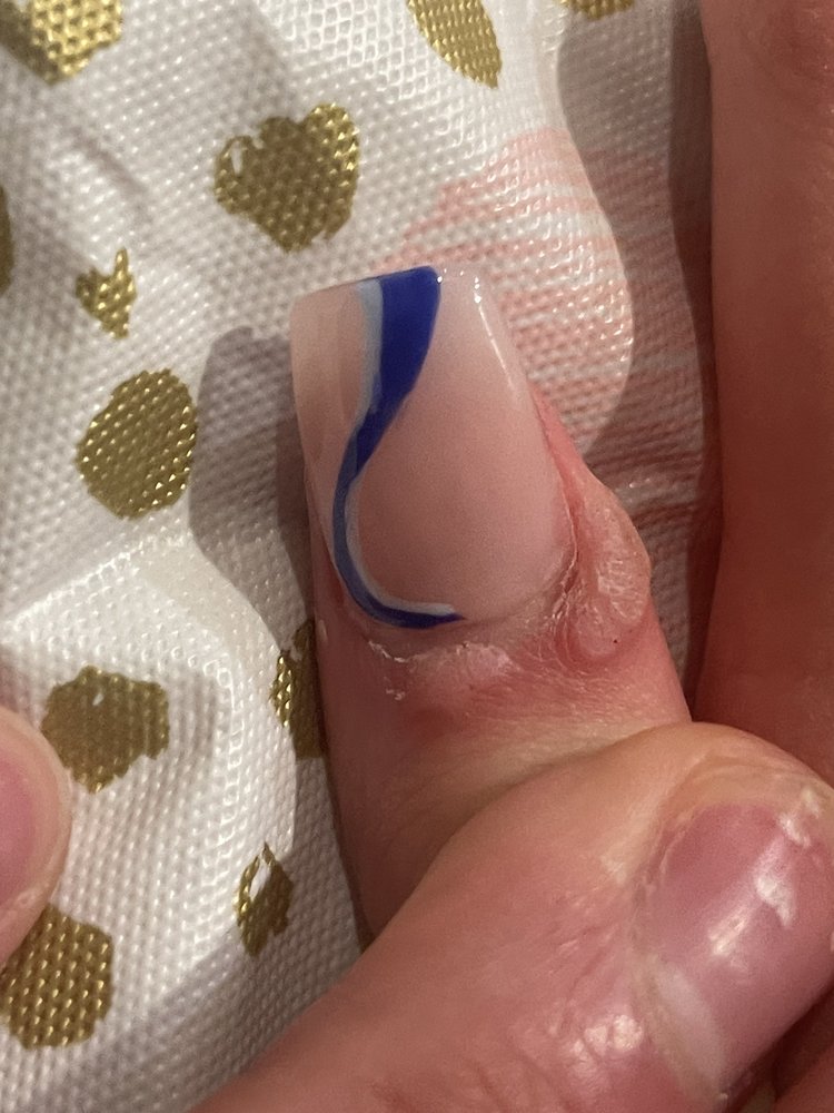 Queen Nails - Ohhh and btw my kid caught an allergic skin reaction from their tools . Don't f w this place - Nail Salons Near Me - Mahopac, New York Queen Nails - Ohhh and btw my kid caught an allergic skin reaction from their tools . Don't f w this place - Nail Salons Near Me - Mahopac, New York