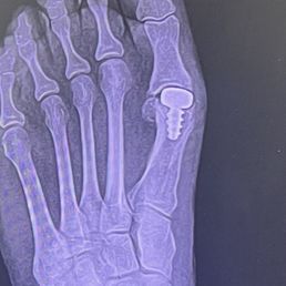 My Frankenstein foot. I feel that screw with every step My Frankenstein foot. I feel that screw with every step