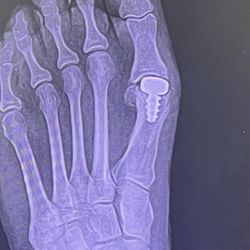 Absolute Foot Care Specialists - My Frankenstein foot. I feel that screw with every step